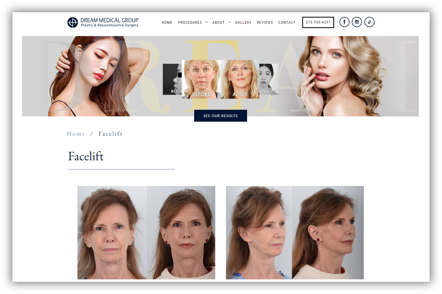 Facelift outcome photographs on a medical website