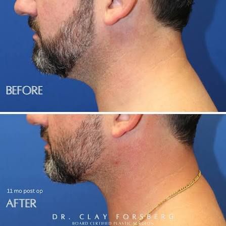 CLAY FORSBERG, MD | Check out our 45-year-old male patient who underwent  neck liposuction! 🌟 This procedure can help eliminate excess fat under the  chin,... | Instagram