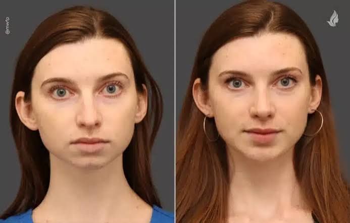 Natural Facial Harmony | Midwest Facial Plastic Surgery