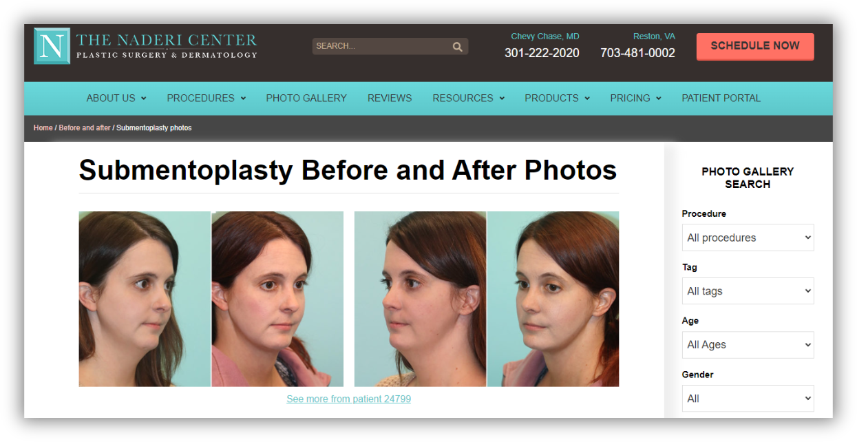 Naderi Center submentoplasty before and after photographs