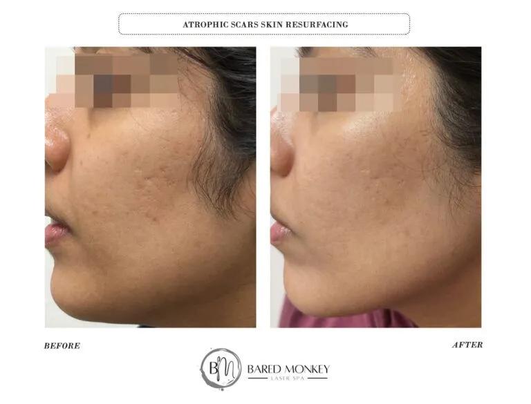 Skin rejuvenation result 7