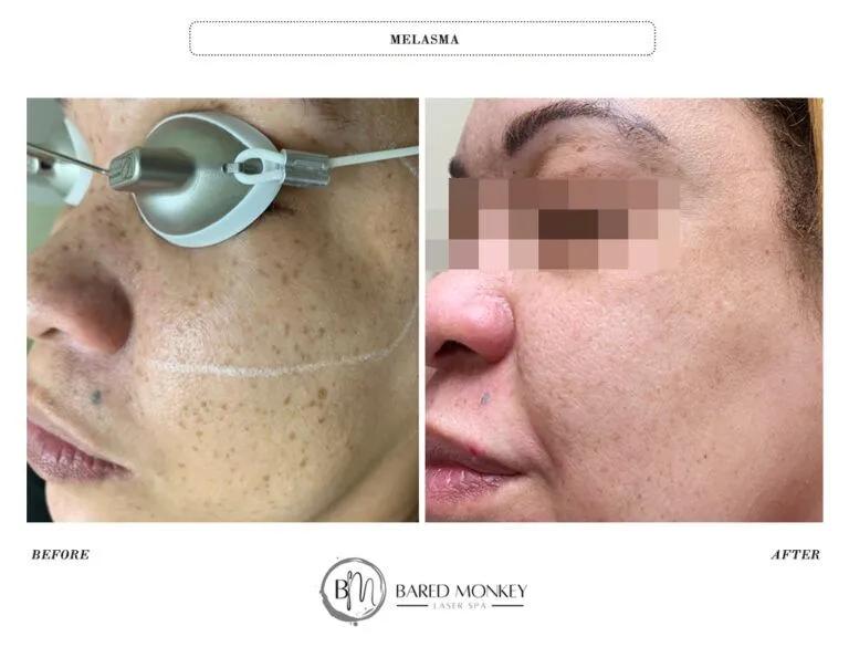 Skin rejuvenation result 37
