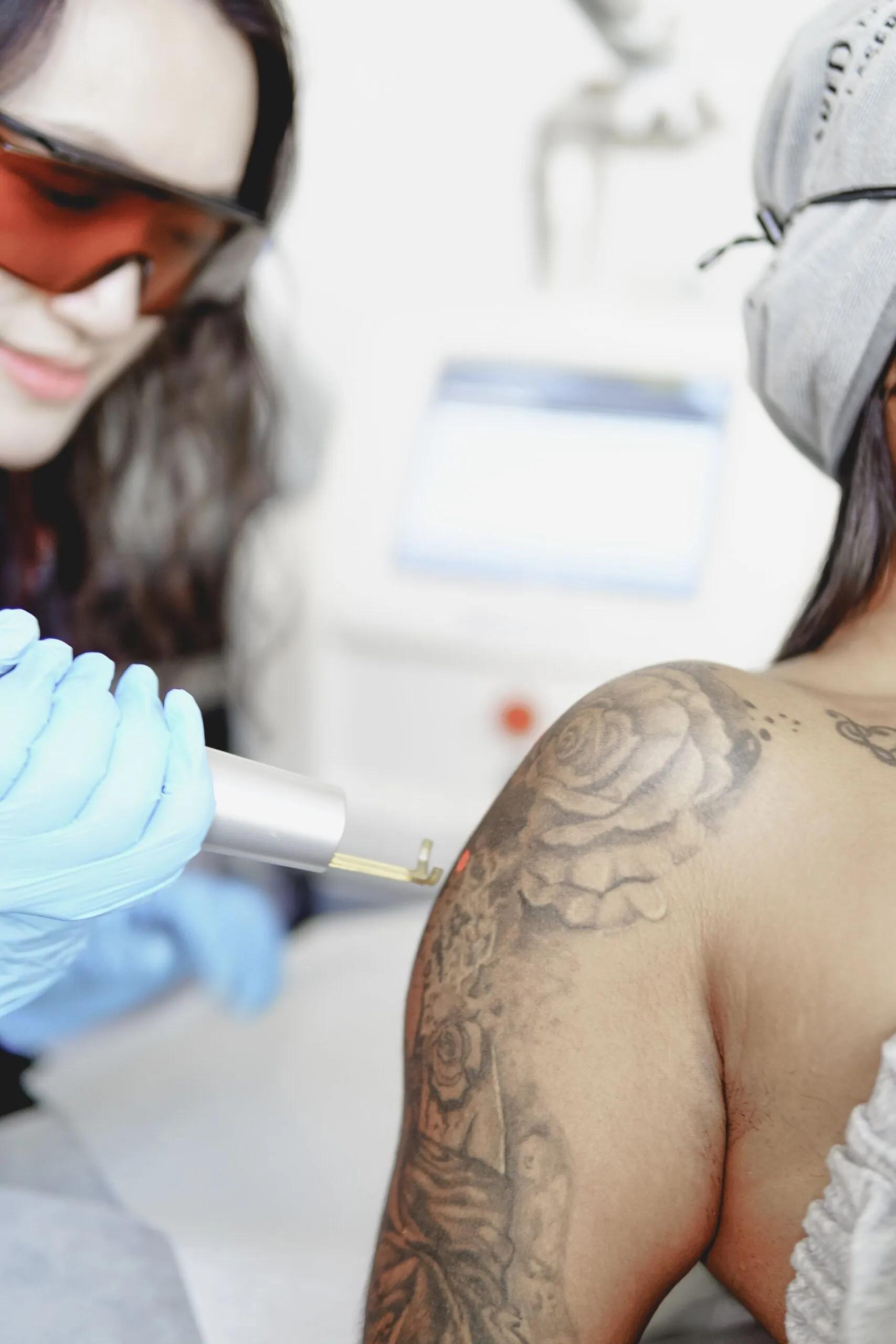 Tattoo removal session