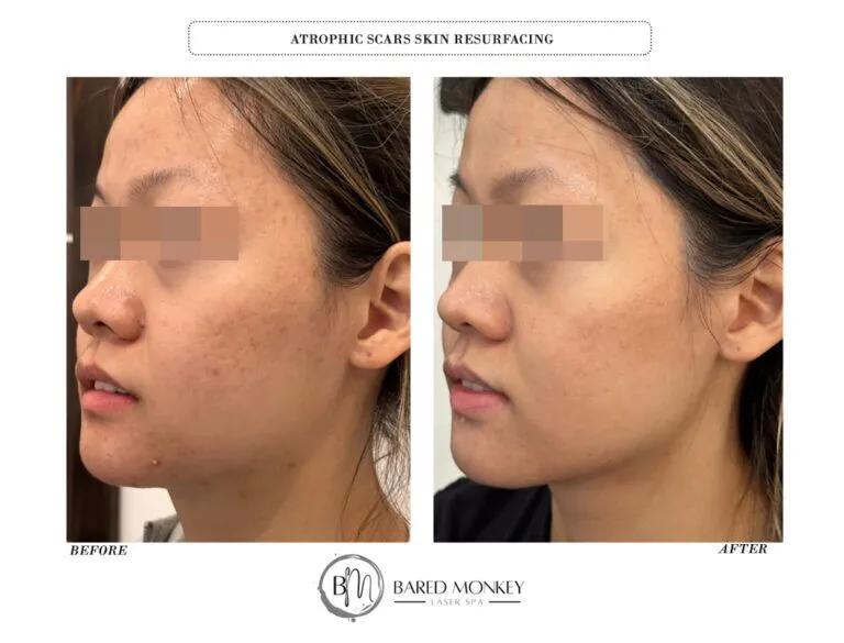 Skin rejuvenation result 3