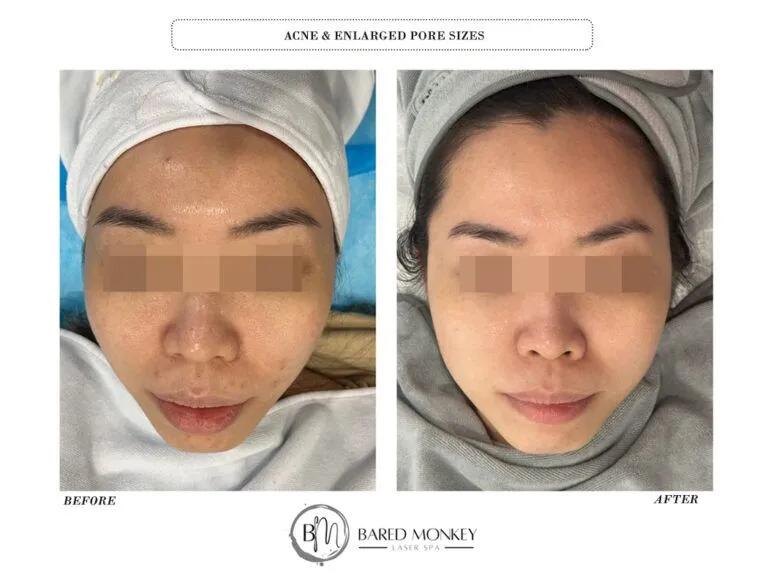 Skin rejuvenation result 12