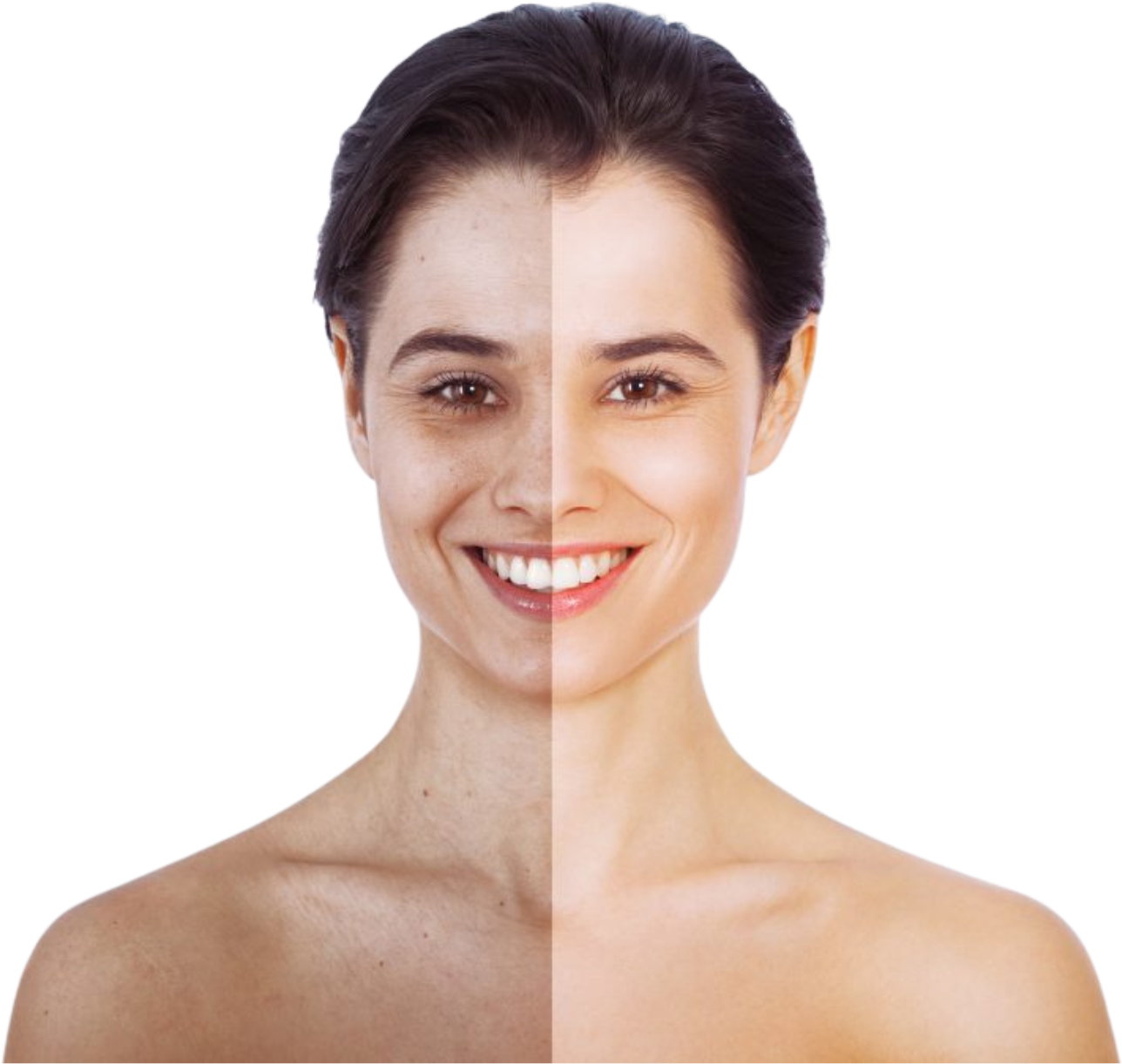 Hollywood Spectra Q-switch laser treatment result