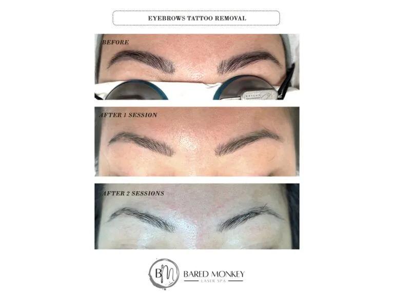 Tattoo removal result 4