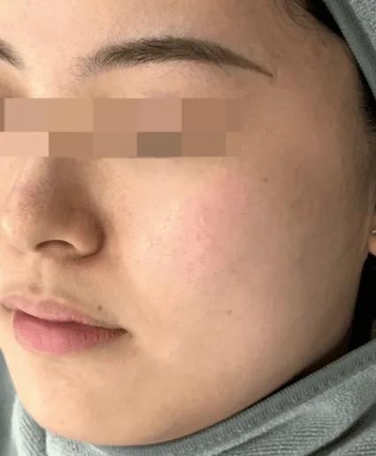 After red acne mark treatment