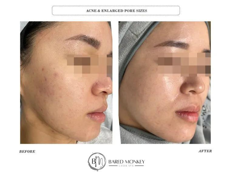 Skin rejuvenation result 17
