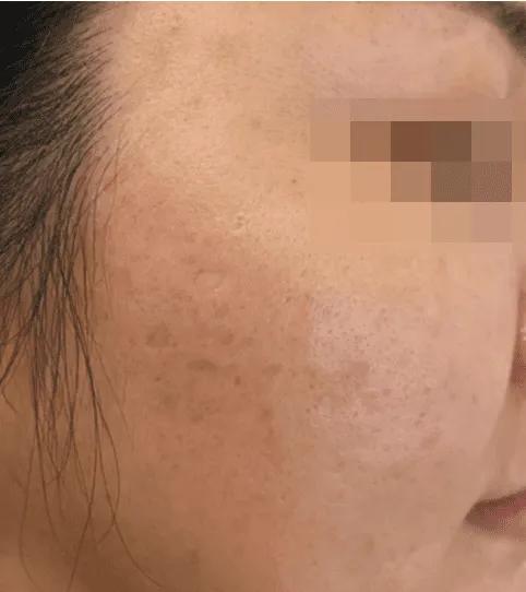 After acne scar treatment