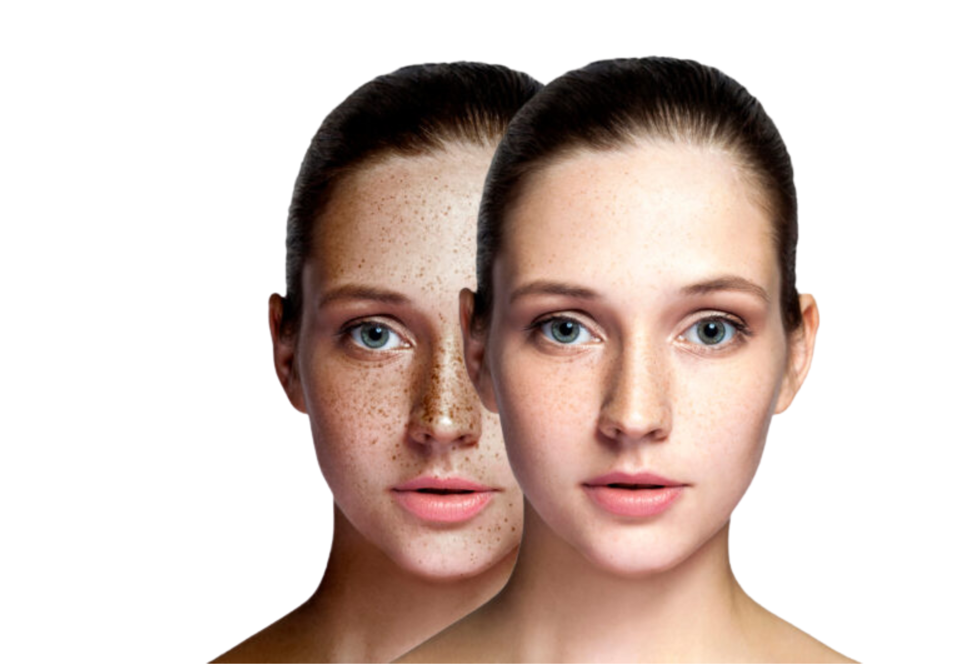 Pico laser treatment