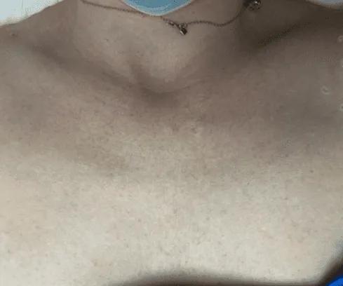 After IPL photofacial improvement