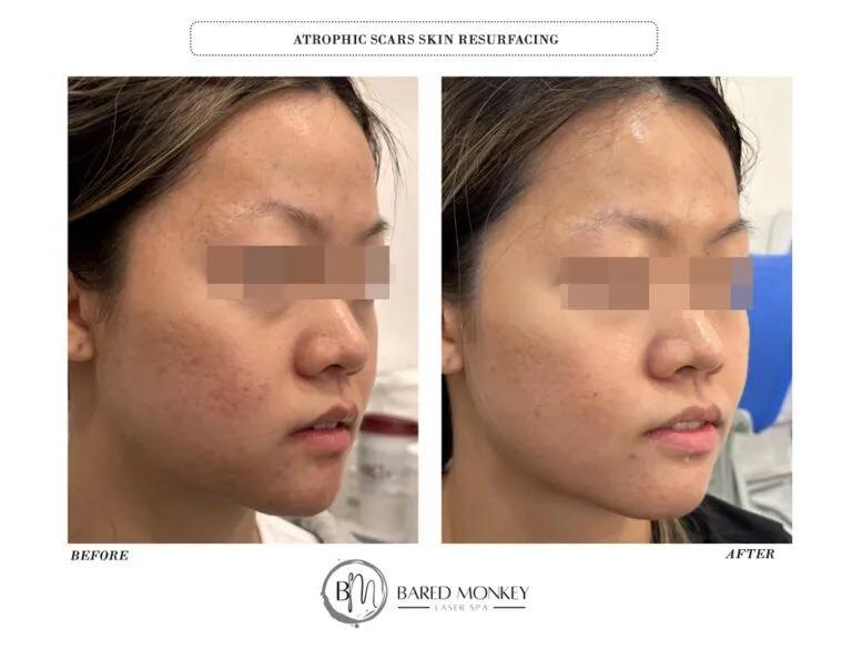 Skin rejuvenation result 4