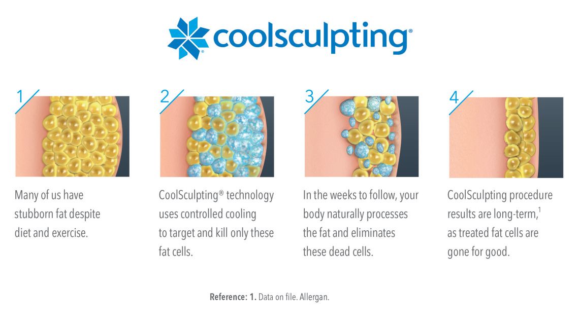 How To Get the Most Out Of Your CoolSculpting® Session
