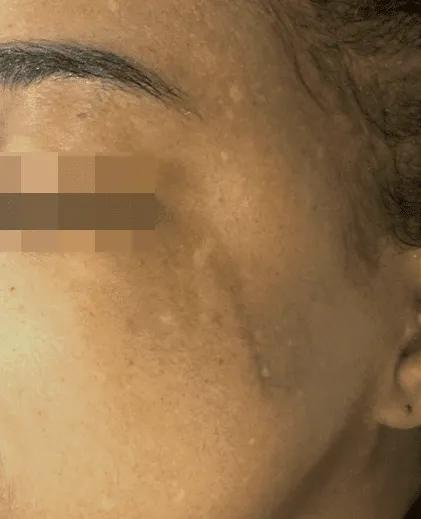 Before dark acne mark treatment