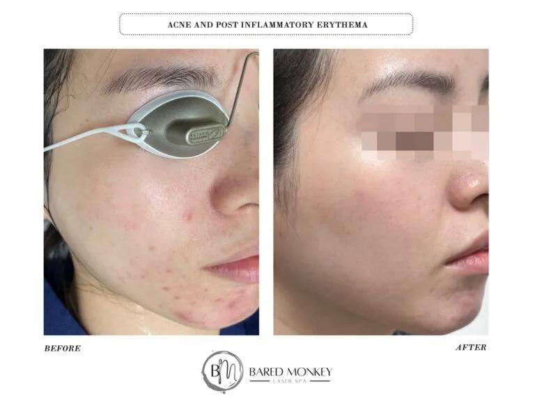 Skin rejuvenation result 1