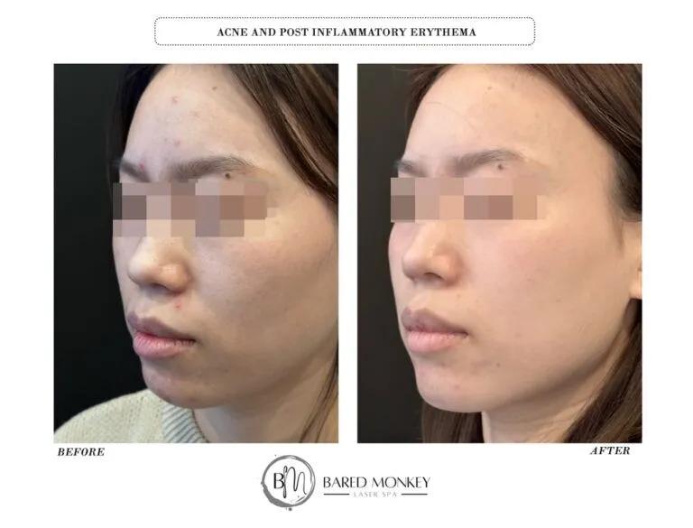 Skin rejuvenation result 19