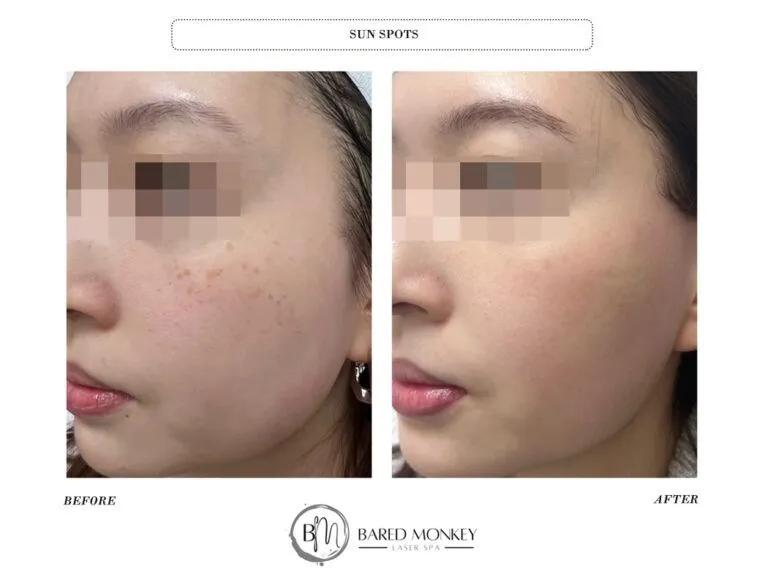 Skin rejuvenation result 38
