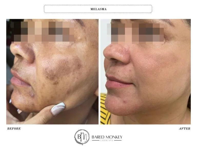 Skin rejuvenation result 36