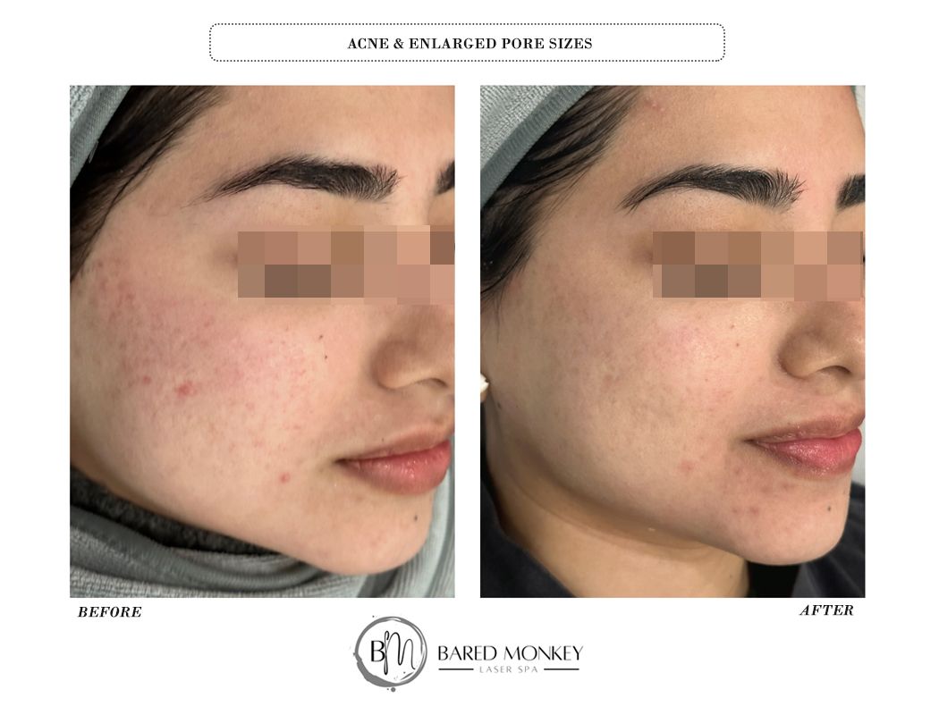 Microneedling result 7
