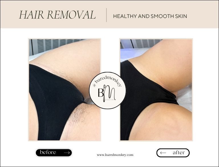 Laser Hair Removal
