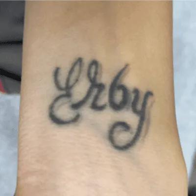 Before tattoo removal session