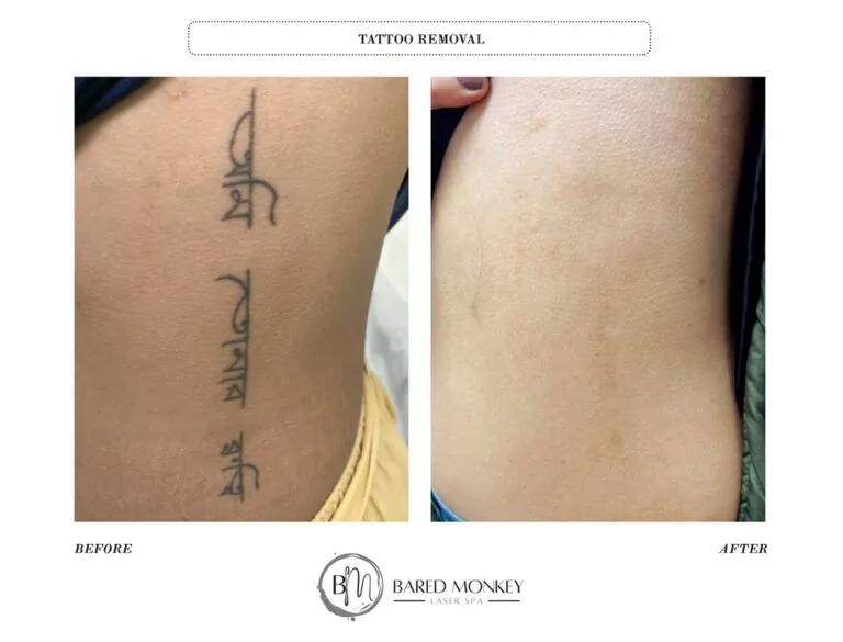 Tattoo removal result 6