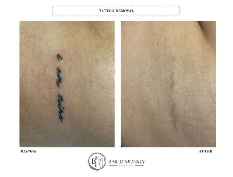 Tattoo removal result 5