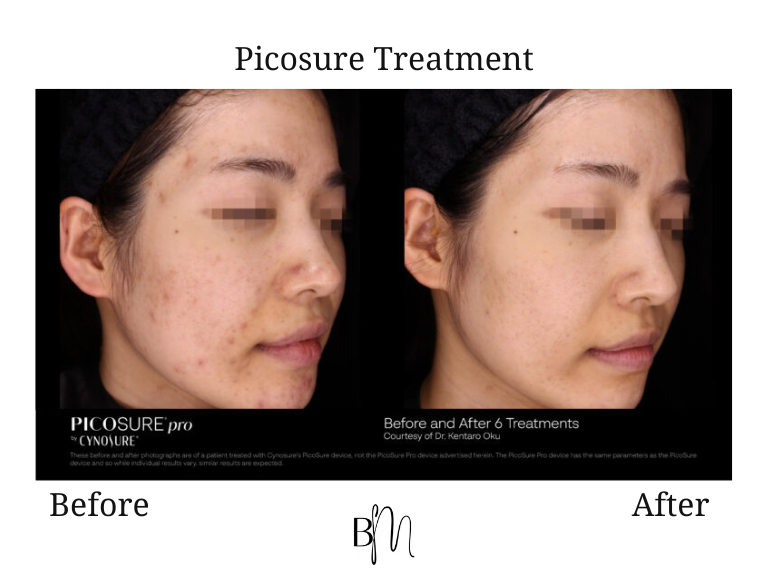 Picosure treatment result 4