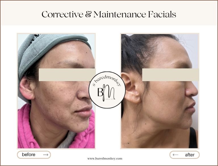 Pico® Skin Rejuvantion