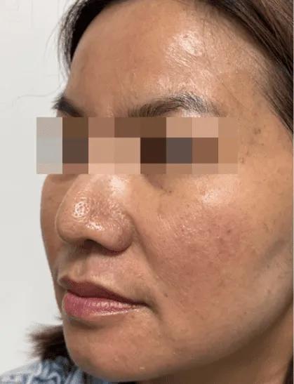 Before fine line treatment