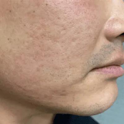 Before Hollywood Spectra treatment