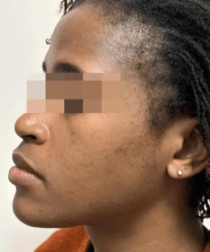 After post-inflammatory pigmentation treatment