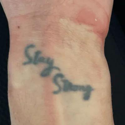 Before tattoo removal