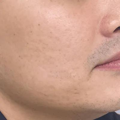 After Hollywood Spectra treatment