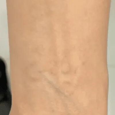 After tattoo removal session