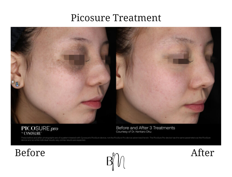 Picosure treatment result 5