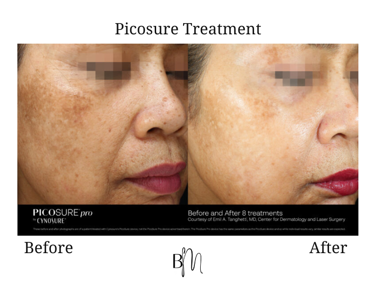 Picosure treatment result 6