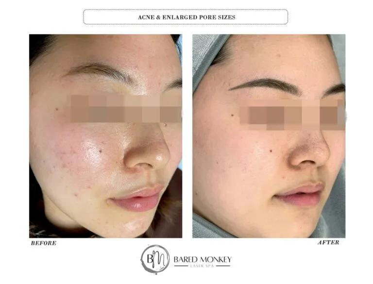 Skin rejuvenation result 13