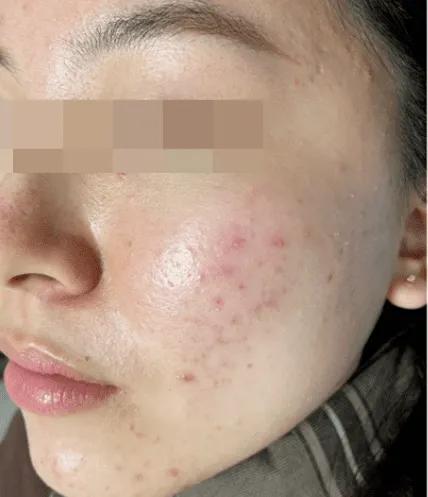 Before red acne mark treatment