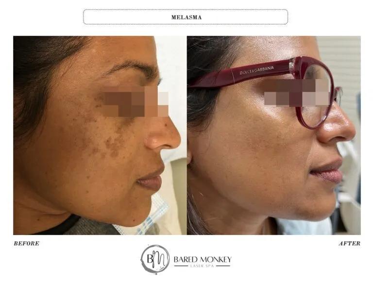Skin rejuvenation result 35