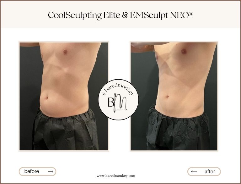 EMSculpt NEO®
