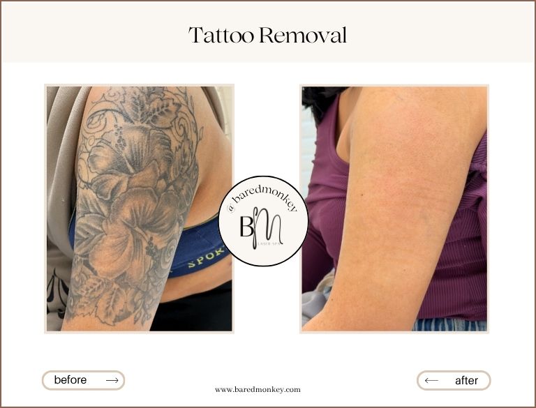 Tattoo Removal