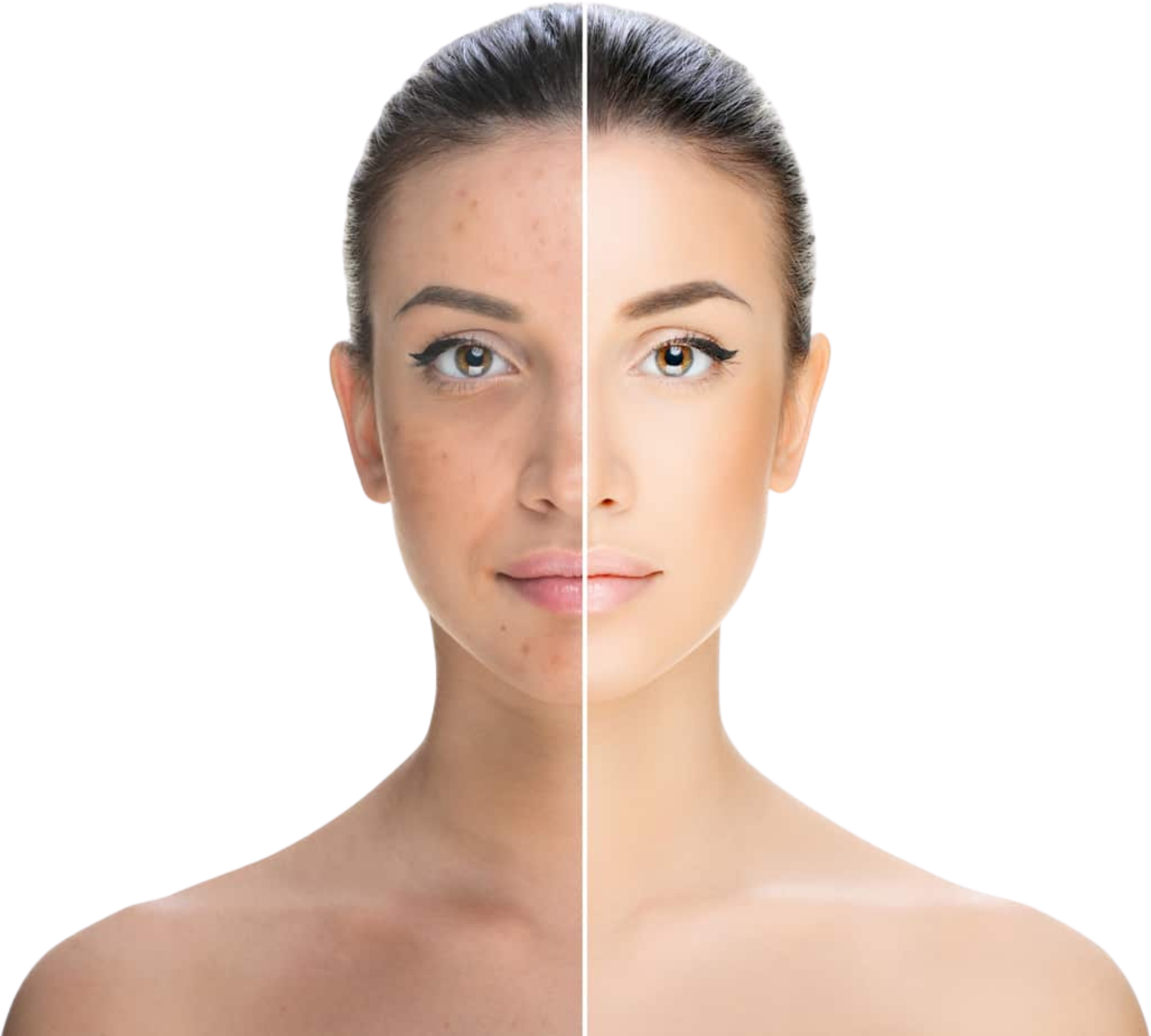 Aviclear laser treatment