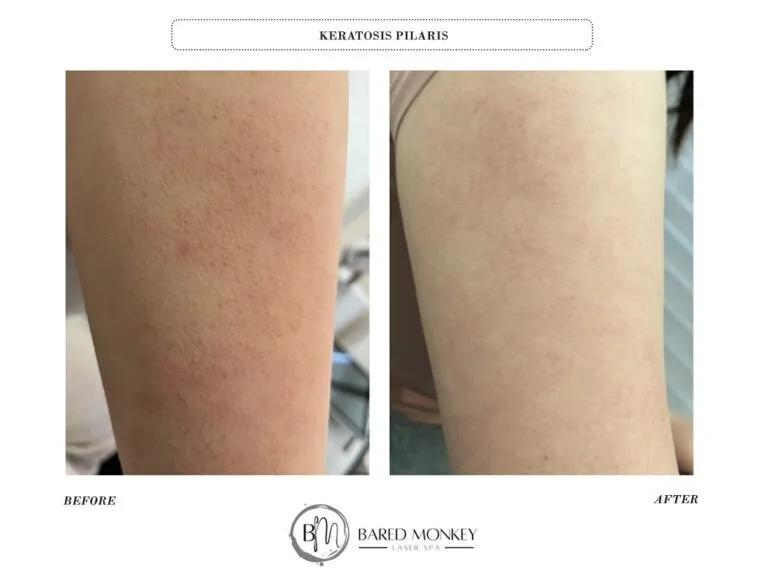 Skin rejuvenation result 33