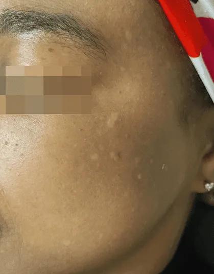 After dark acne mark treatment