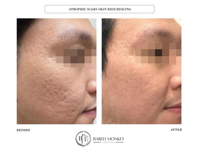 Skin rejuvenation result 9