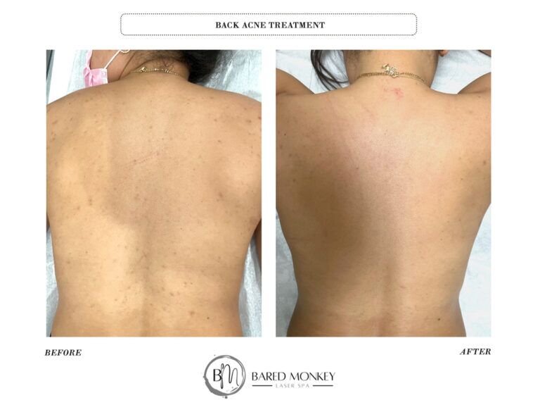 Skin rejuvenation result 25