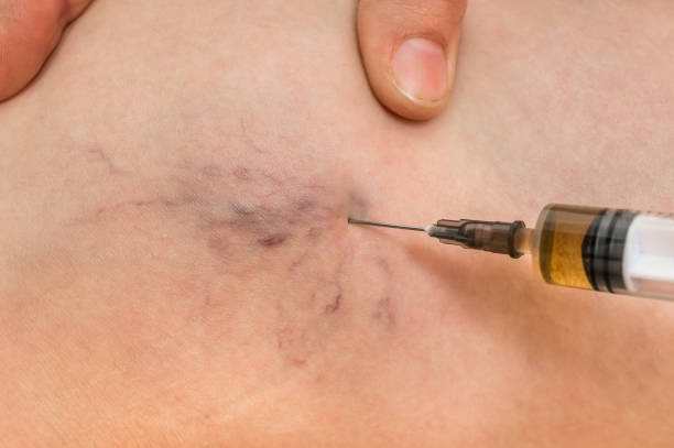 Laser-Vein-Treatment