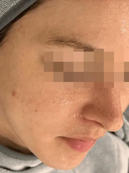 After skin flushing treatment